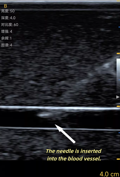 Ultrasound Vascular Puncture T - Medical Gel Ultrasound recensie en prijs